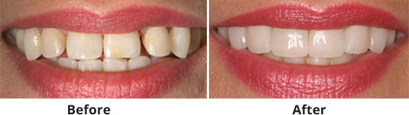 veneers-image